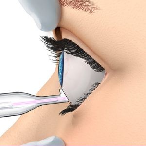Laser mikropulsowy